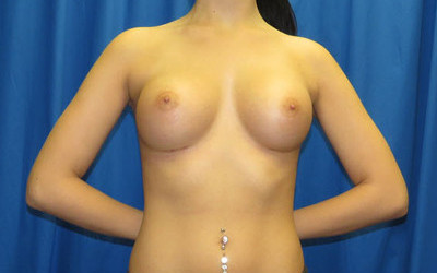 Breast enlargement after