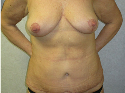 Breast lift after