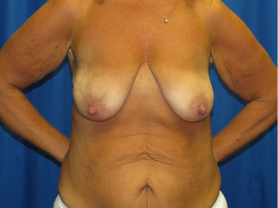 Breast lift before