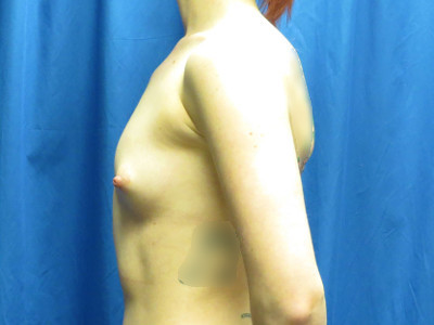 Breast enlargement side image before