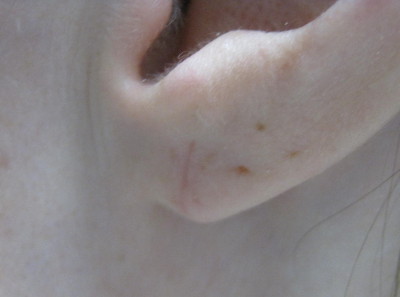 Ear repair after