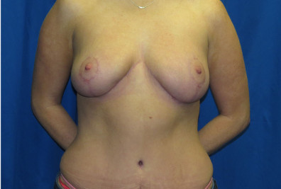 Reduction and tummy tuck after