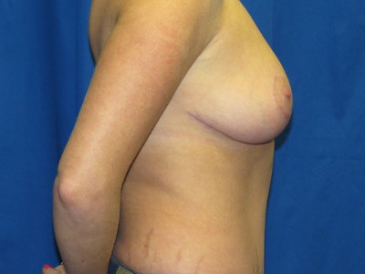 reduction and tummy tuck after