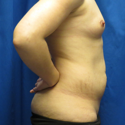 Before image - Breast enlargement & Tummy Tuck