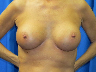 Breast enlargement after image