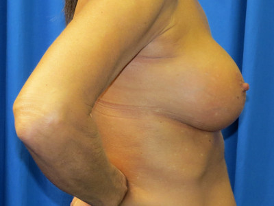 Breast enlargement side after image
