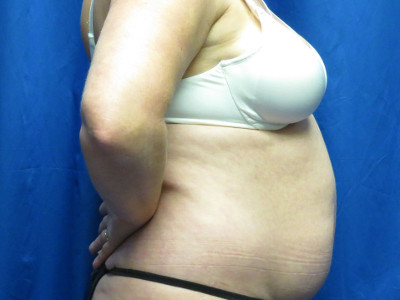 Liposuction before