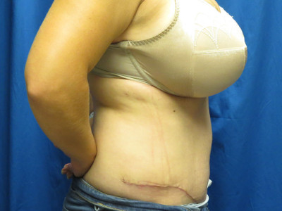 Tummy tuck after